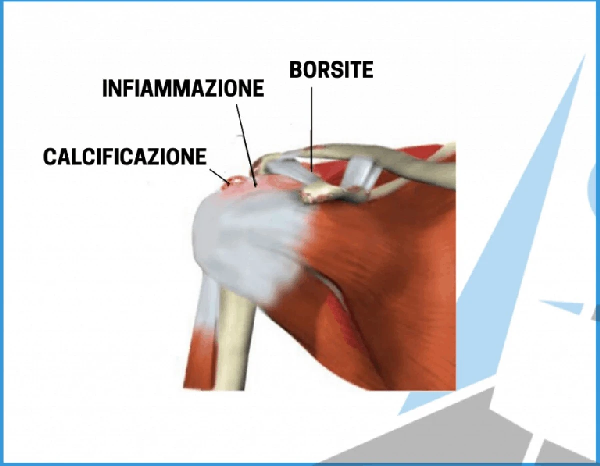 La protesi inversa di spalla: un'innovazione che sta cambiando la vita dei pazienti in Italia - image 1